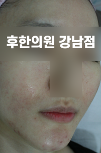 치료 전