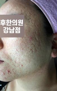 치료 전