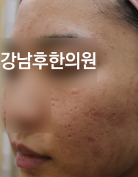 치료 전
