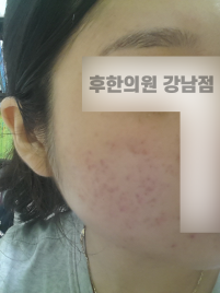 치료 전