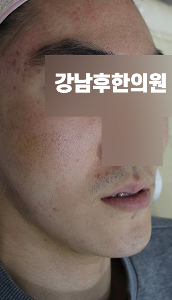 치료 전