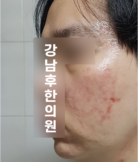 치료 후