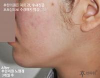 치료 후