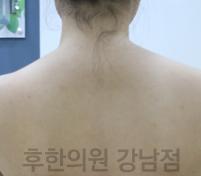 치료 후