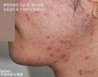 치료 전