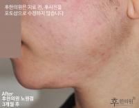 치료 후