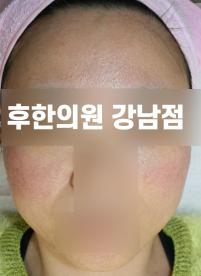 치료 후