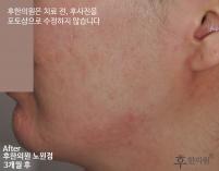 치료 후