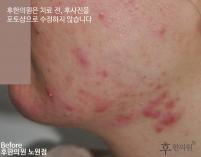 치료 전