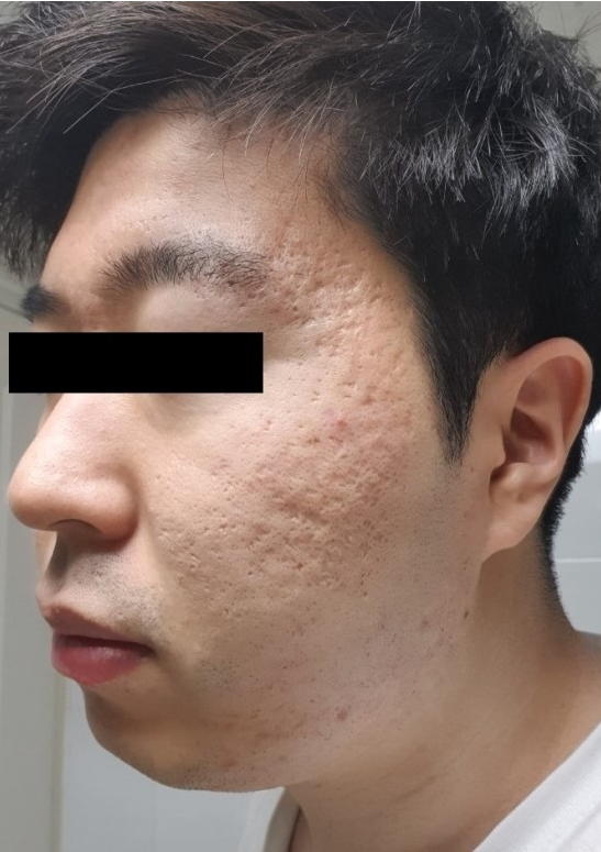 치료 전