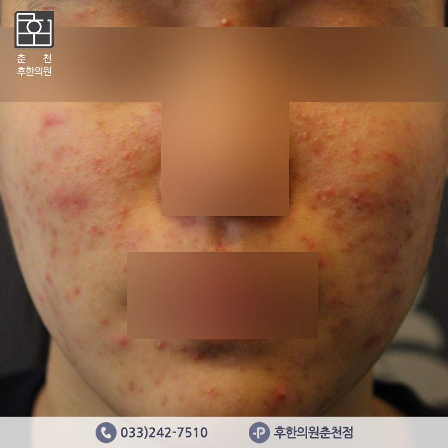 치료 전