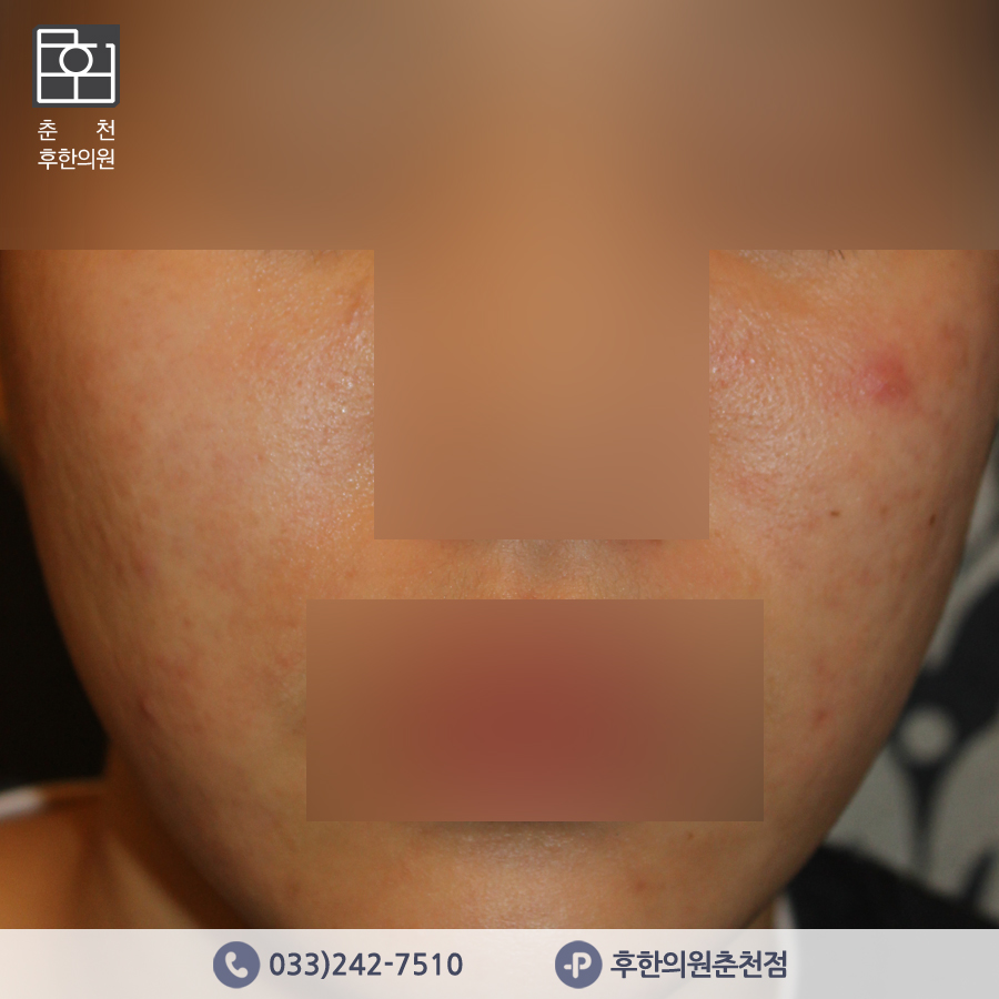 치료 후