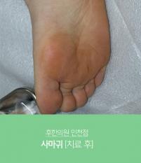 치료 후