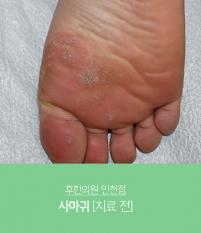 치료 전