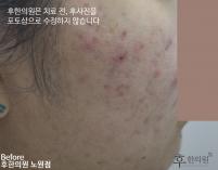 치료 전