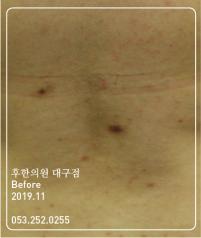 치료 전