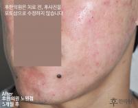 치료 후
