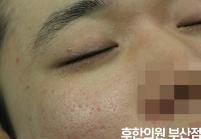 치료 전