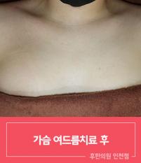 치료 후