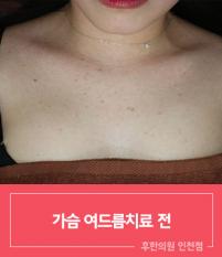 치료 전
