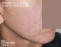 치료 후