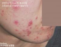 치료 전