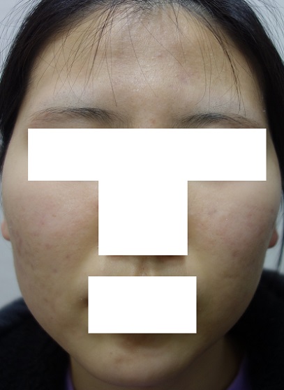 치료 후