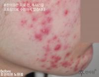 치료 전