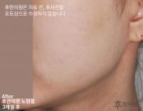 치료 후