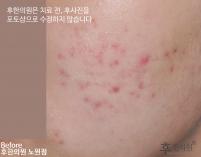 치료 전