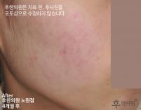 치료 후