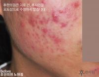 치료 전