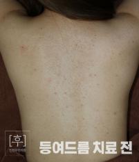치료 전