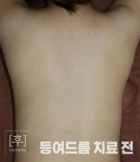 치료 후