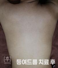 치료 후