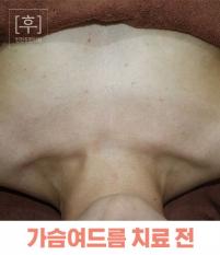 치료 전