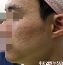 치료 전
