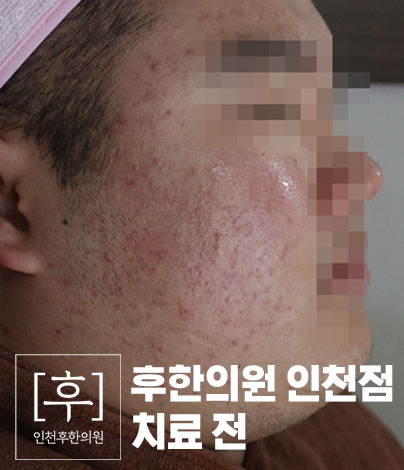 치료 전