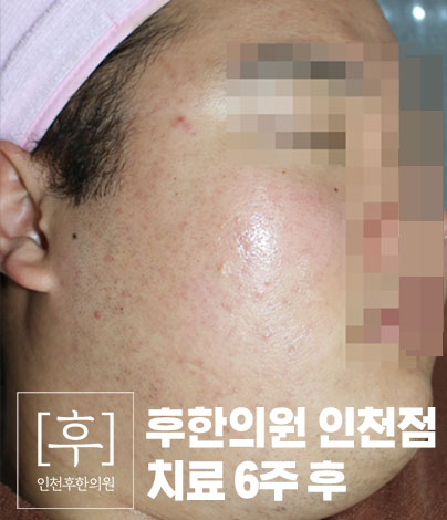 치료 후