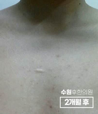 치료 후