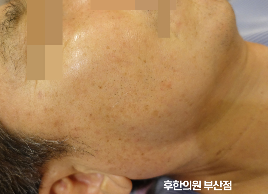 치료 후
