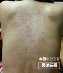 치료 전