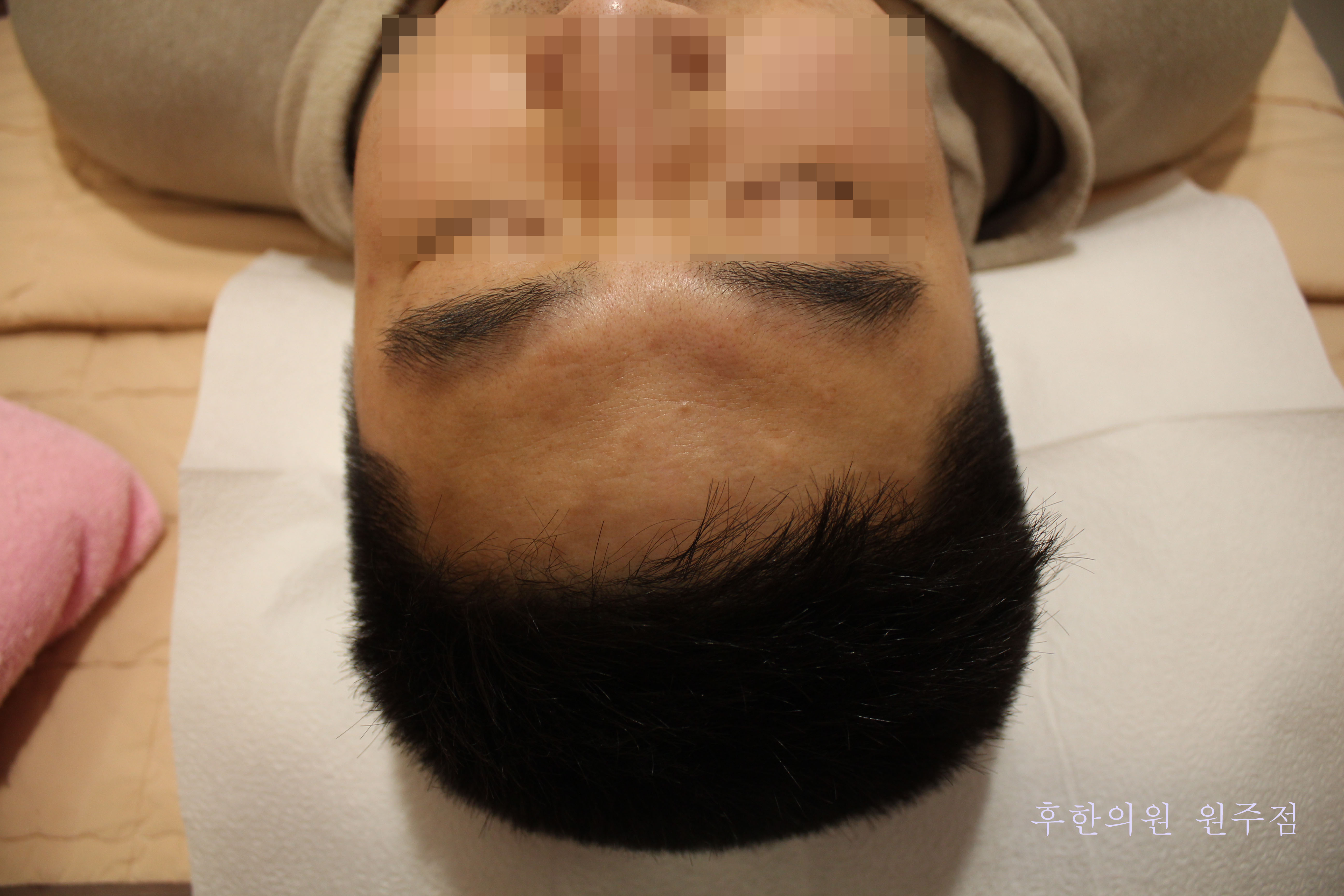 치료 후