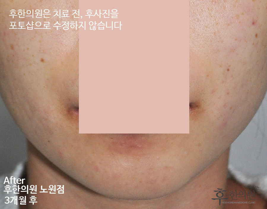 치료 후