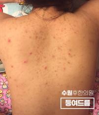 치료 전