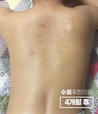 치료 후