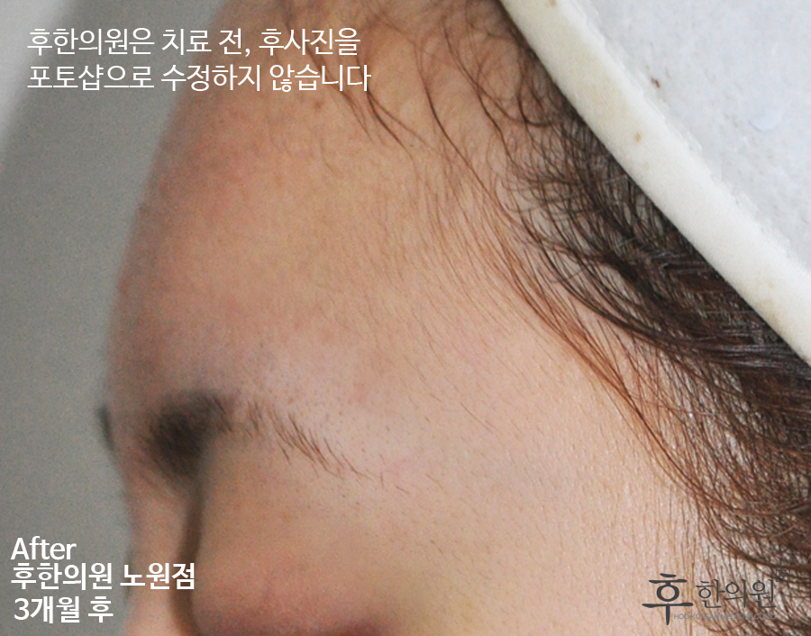 치료 후