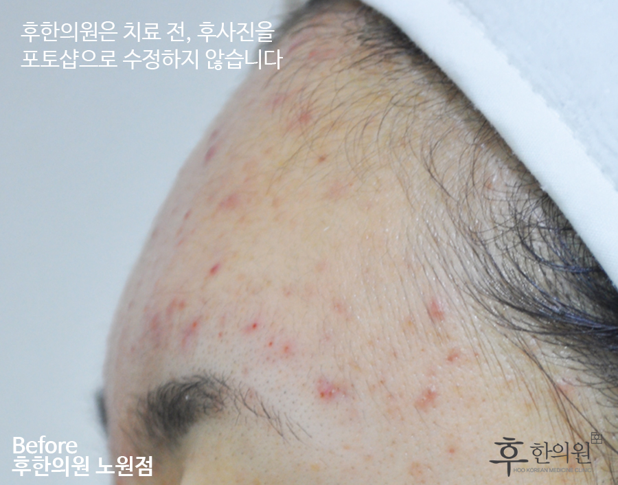 치료 전