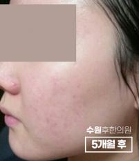 치료 후