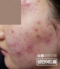 치료 전